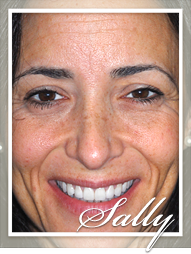 Smile Makeovers - Sally