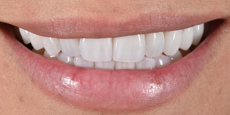 Elite Smile Makeover | Beverly Hills Dentistry